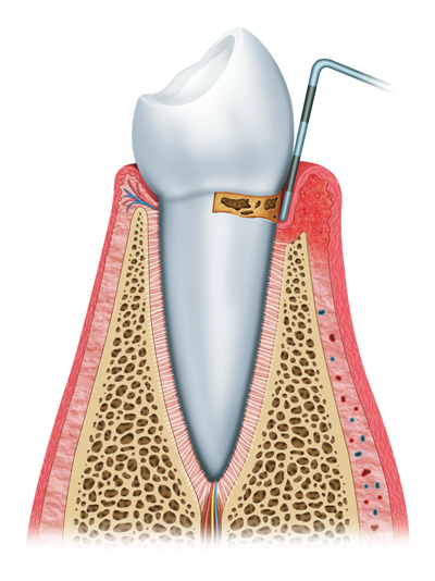 Stages of Gum Disease Burnaby, BC