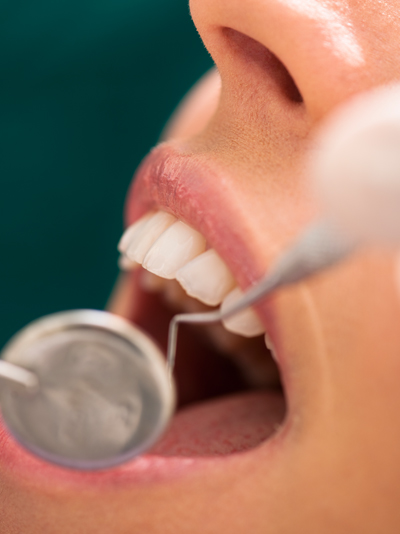 Periodontal Maintenance in Burnaby, BC