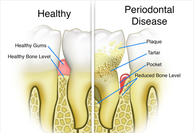 Gum Disease and Tooth and Bone Loss Burnaby, BC