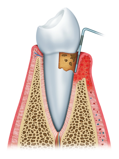 Stages of Gum Disease Burnaby, BC